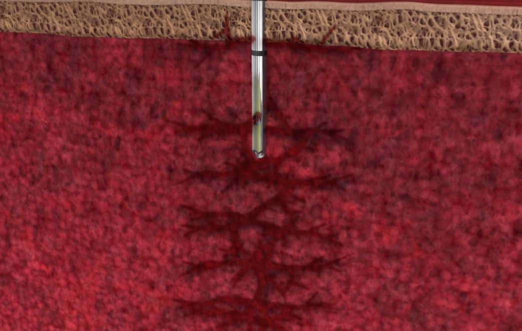 Cervos BMA closed distal tip with side-port aspiration into undisturbed cancellous bone