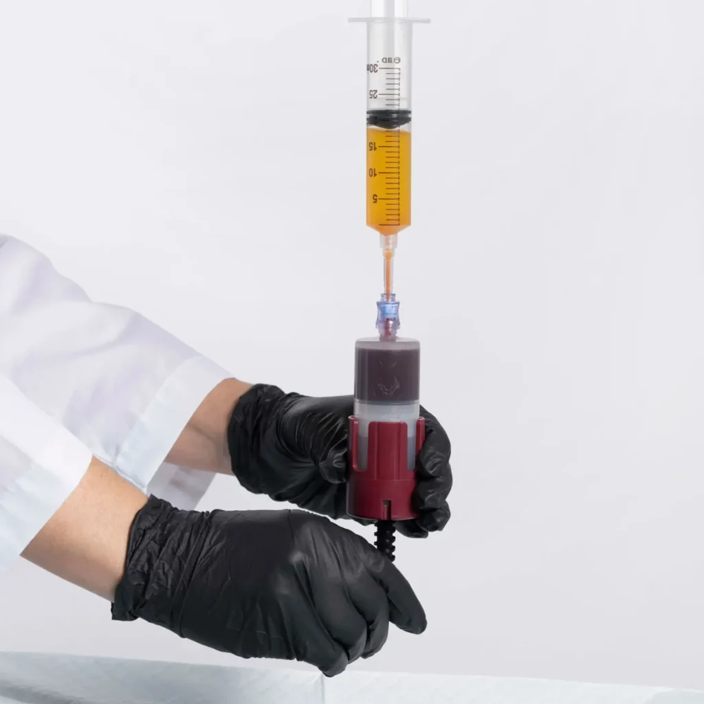 Clinician decanting platelet-rich plasma with the KeyPRP system