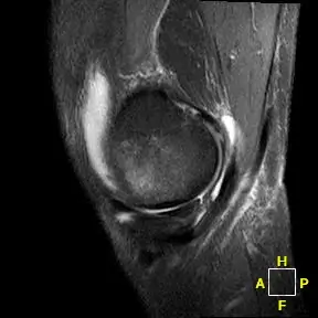 Patient One sagittal radiograph, pre-operative