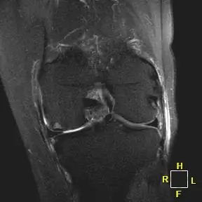 Patient One AP radiograph, 3 months post-operative