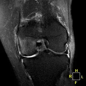 Patient One AP radiograph, pre-operative