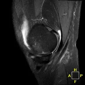 Patient One sagittal radiograph, 3 months post-operative