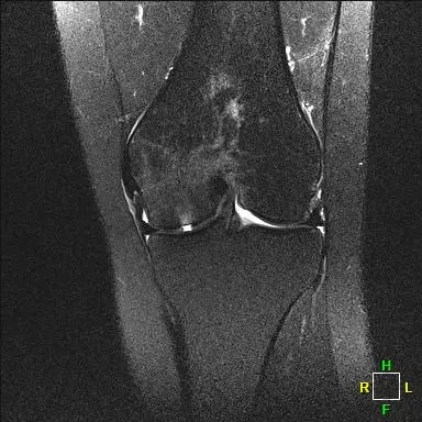 Patient Two AP radiograph, 3 months post-operative