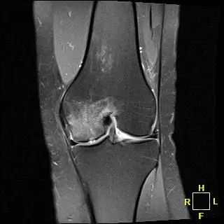 Patient Two AP radiograph, pre-operative