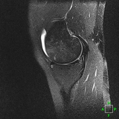 Patient Two sagittal radiograph, 1 month post-operative