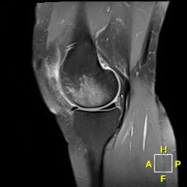 Patient Two sagittal radiograph, pre-operative