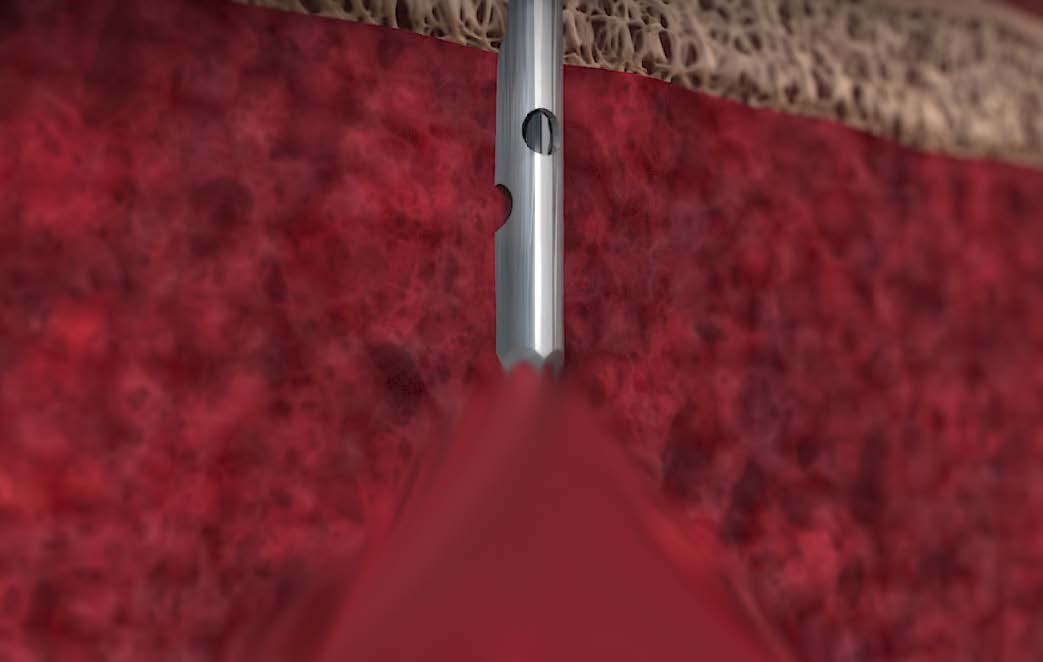 Traditional open-tip trocar needle aspirating peripheral blood alongside marrow